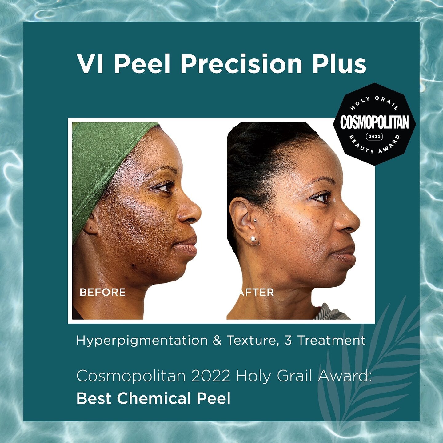 Tox Forward - 30 Units Xeomin + Precision Plus VI Peel