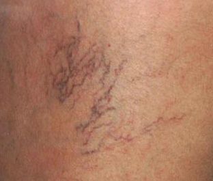 Vein You See It, Now You Don’t - $50 Off Sclerotherapy
