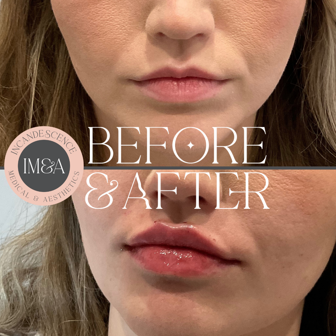 The Countless Contour - $100 Off Filler