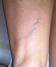 Vein You See It, Now You Don’t - $50 Off Sclerotherapy