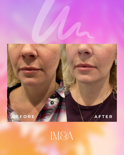Barefaced Glow - Ultherapy Prime Chin Strap Treatment + Microneedling