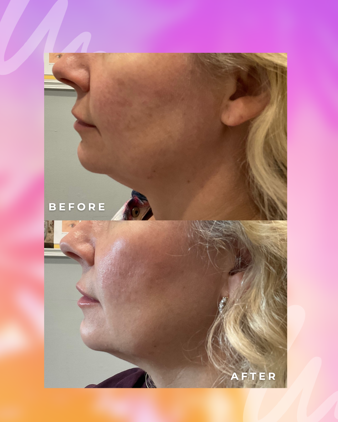 Barefaced Glow - Ultherapy Prime Chin Strap Treatment + Microneedling