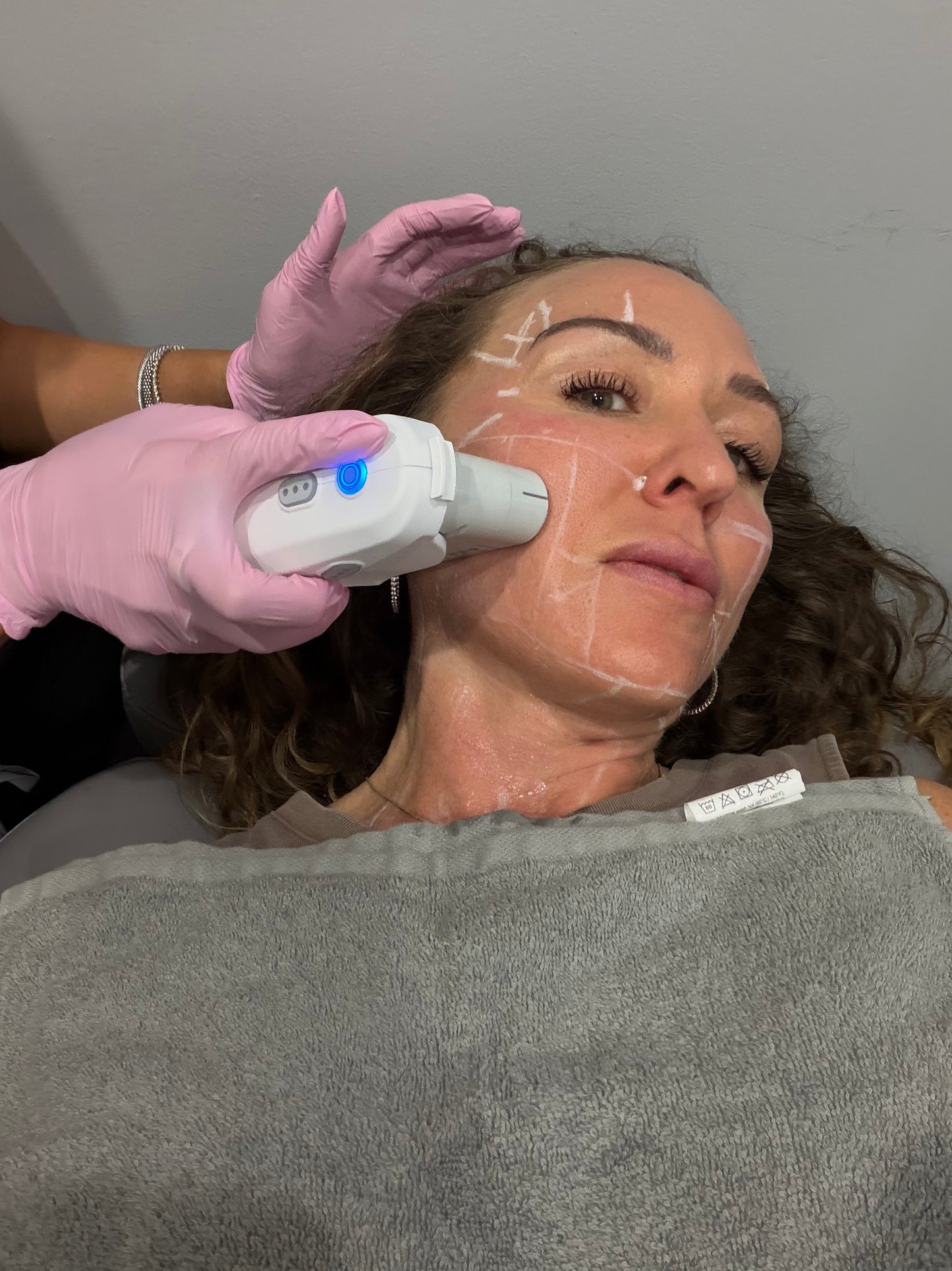 Hot Girl Lift - Ultherapy Prime — Lower Face (includes cheeks and upper neck) 35% Off