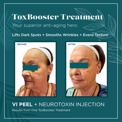 Hands on Glow with Andrea, RN - Tox Booster Treatment - VI Peel + Tox