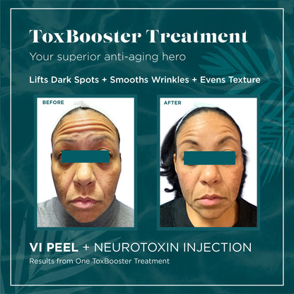 Hands on Glow with Andrea, RN - Tox Booster Treatment - VI Peel + Tox