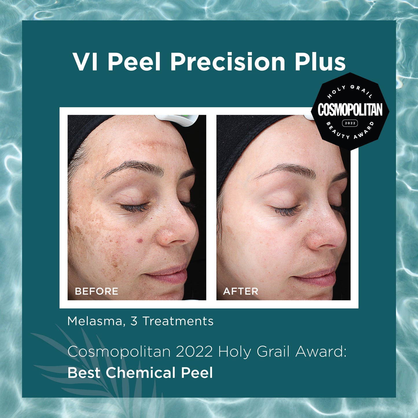 New Year, New Skin - VI Peel Special - Precision Plus