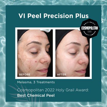 New Year, New Skin - VI Peel Special - Precision Plus